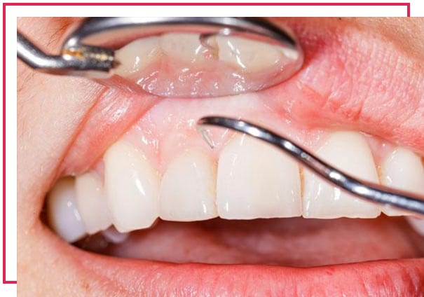 Diş Eti Hastalıkları Nelerdir?